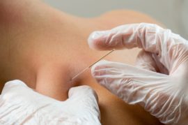dry needling treatment for muscle pain relief