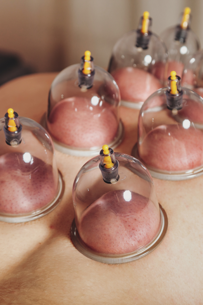 cupping therapy treatment performed by physical therapist
